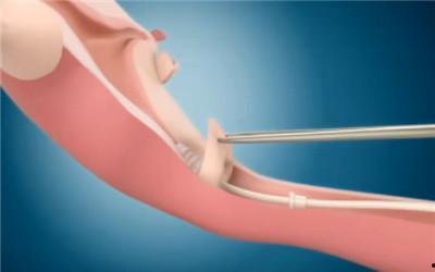 上环手术视频,专业视角下的操作步骤与注意事项